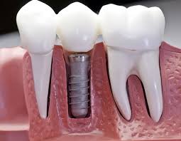 What risks are involved with dental implants?